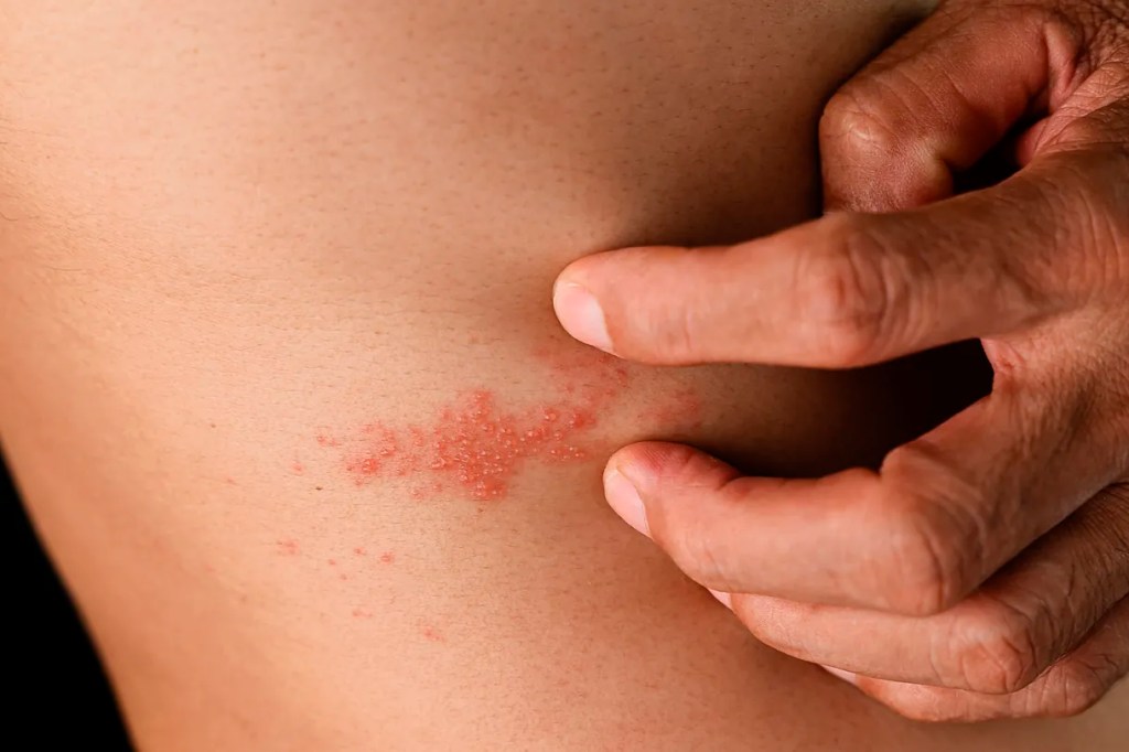 Un ensayo fortuito constata la eficacia de la vacuna del herpes frente a la&nbsp;demencia